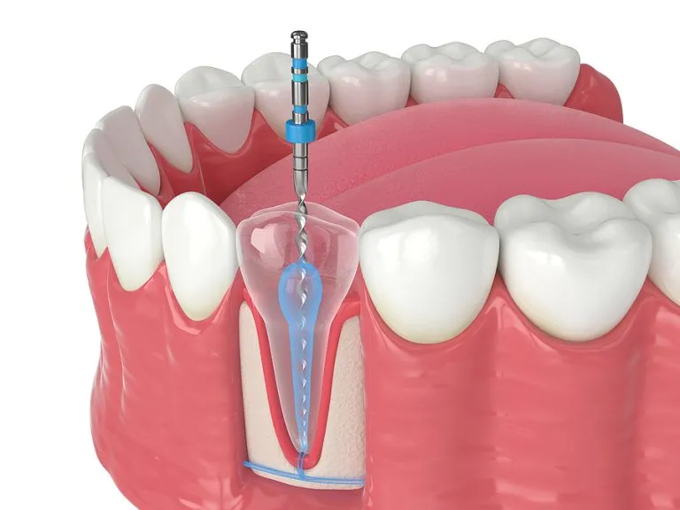 Understanding Endodontics in Lubbock, TX: A Guide to Root Canal Treatment and More