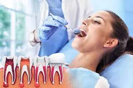 Can Root Canal Treatment Really Save a Tooth?